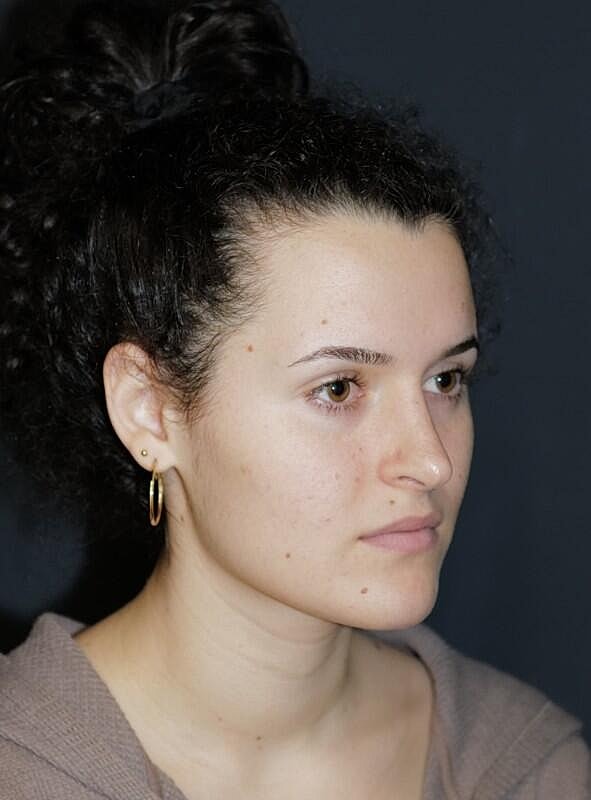 Rhinoplasty Before & After