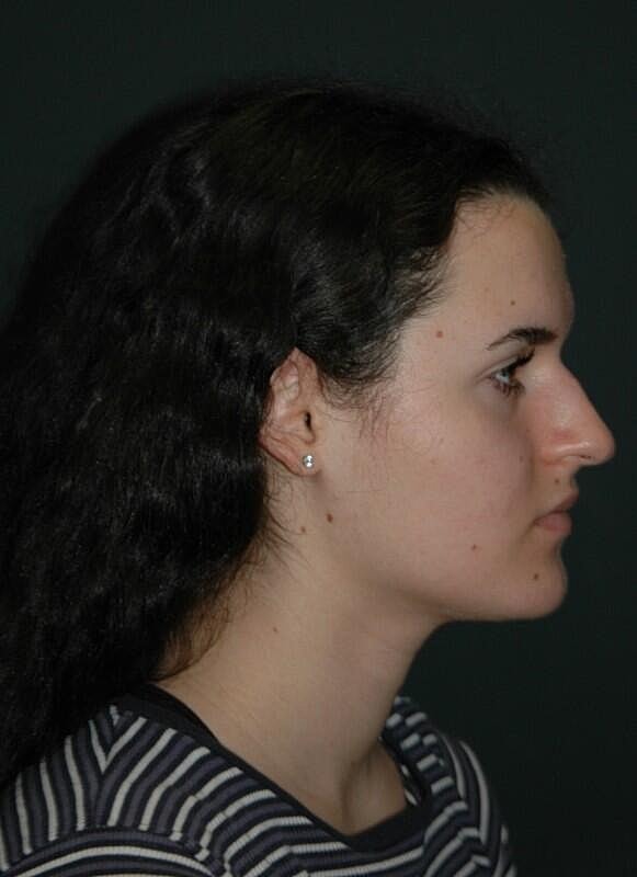 Rhinoplasty Before & After