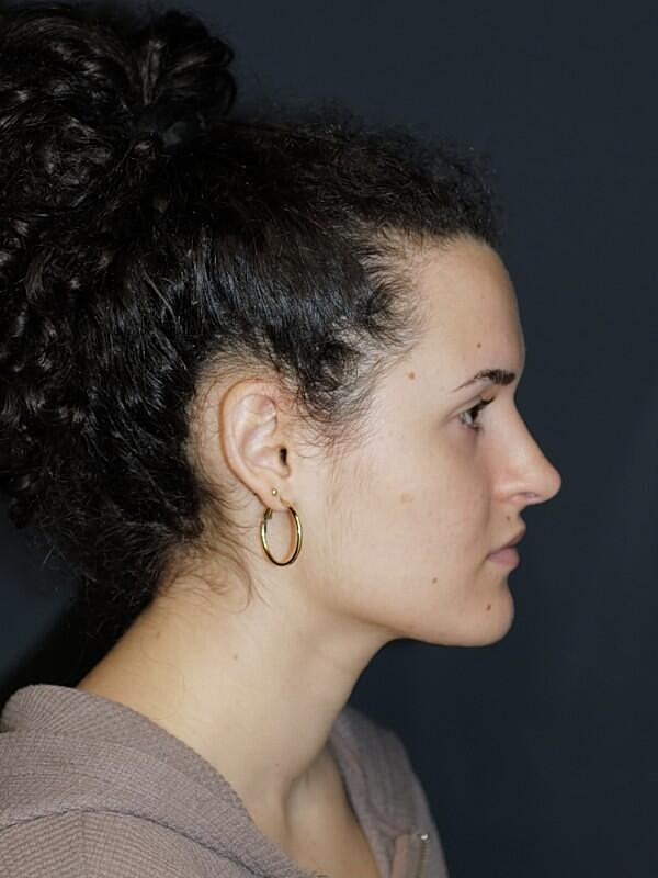 Rhinoplasty Before & After