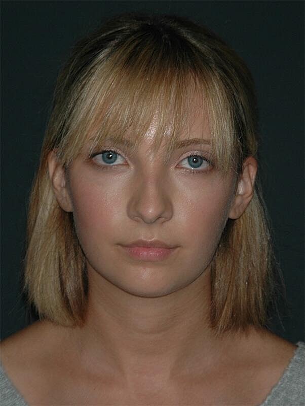 Rhinoplasty Before & After