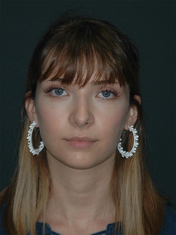 Rhinoplasty Before & After