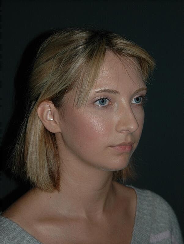 Rhinoplasty Before & After