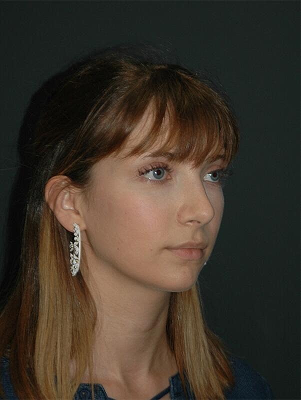 Rhinoplasty Before & After