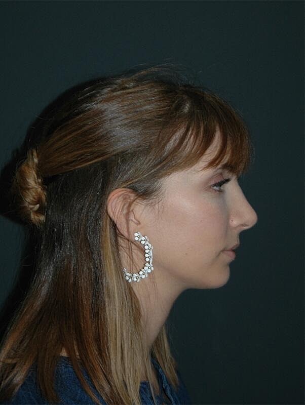 Rhinoplasty Before & After