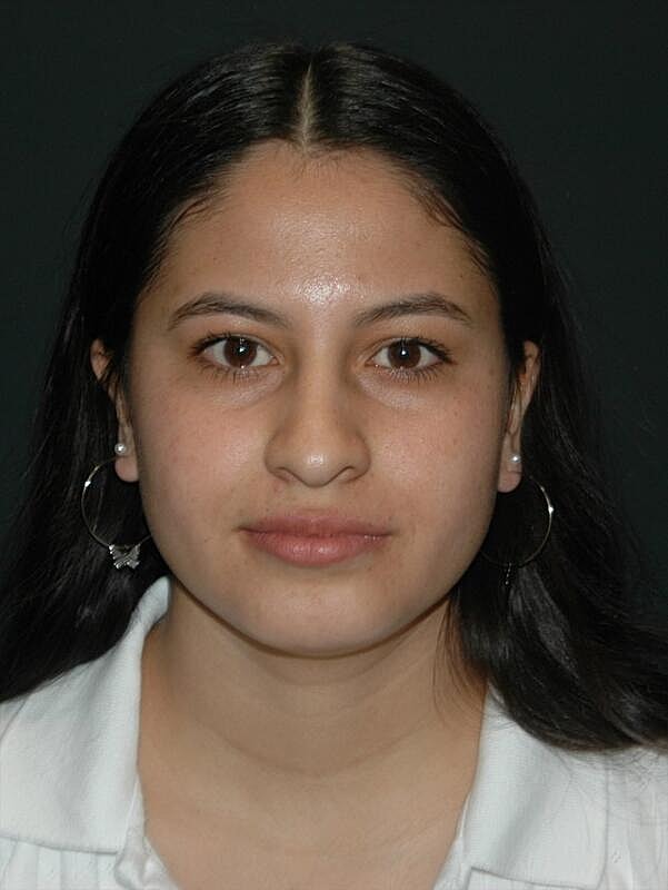 Rhinoplasty Before & After