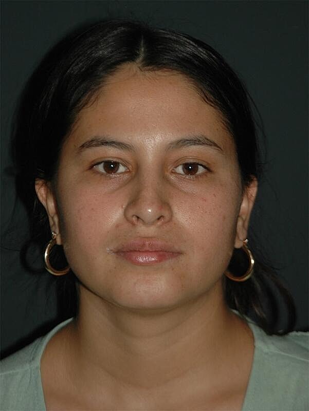 Rhinoplasty Before & After