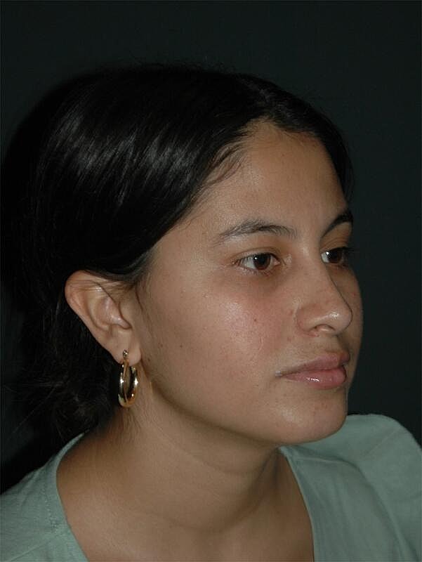 Rhinoplasty Before & After