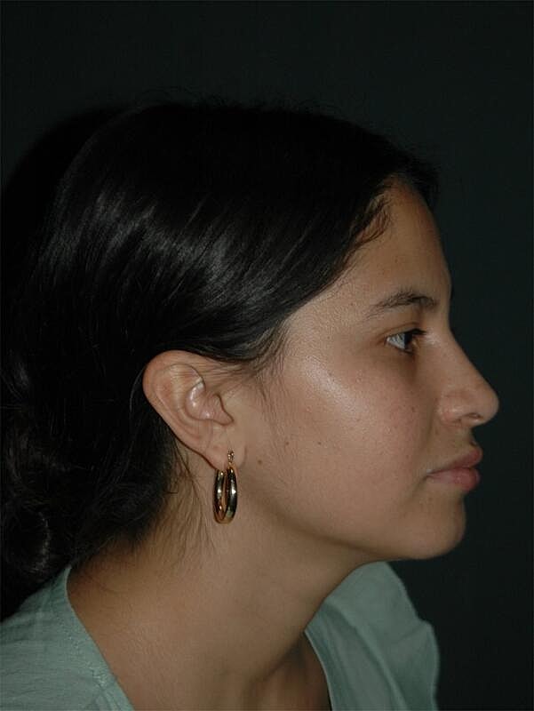 Rhinoplasty Before & After