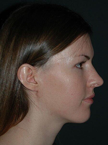 Rhinoplasty Before & After