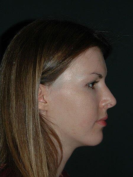 Rhinoplasty Before & After