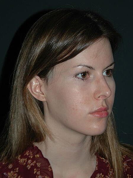 Rhinoplasty Before & After