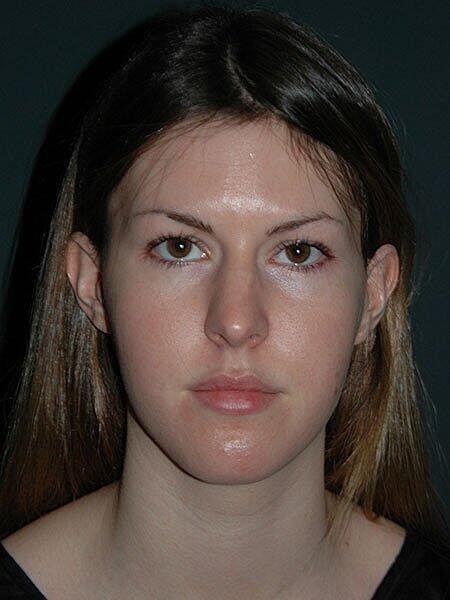 Rhinoplasty Before & After