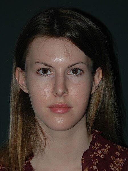 Rhinoplasty Before & After