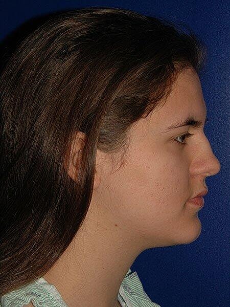 Rhinoplasty Before & After