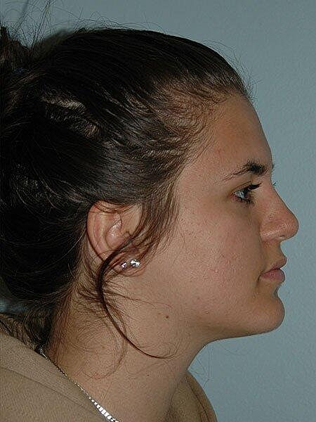 Rhinoplasty Before & After