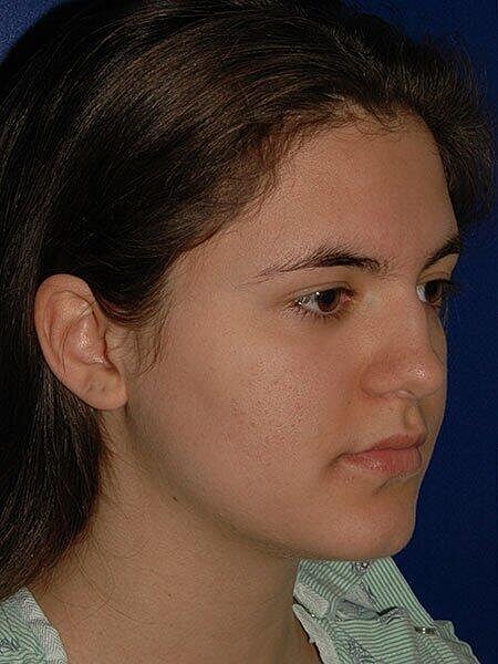 Rhinoplasty Before & After