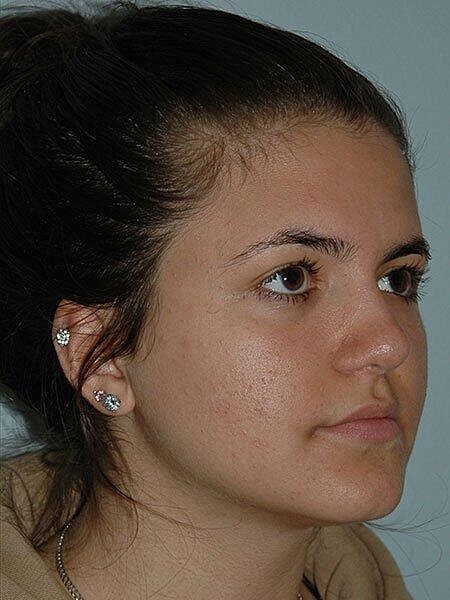 Rhinoplasty Before & After