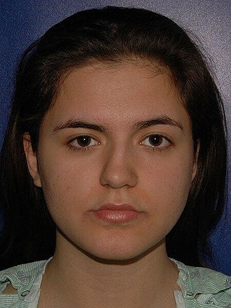 Rhinoplasty Before & After