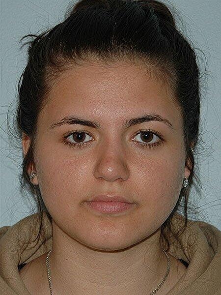 Rhinoplasty Before & After