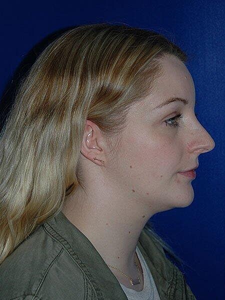 Rhinoplasty Before & After