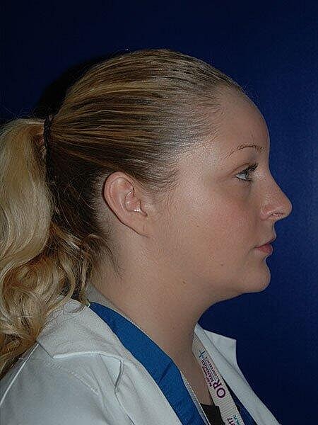 Rhinoplasty Before & After