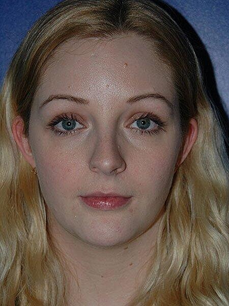 Rhinoplasty Before & After