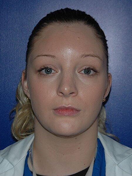 Rhinoplasty Before & After