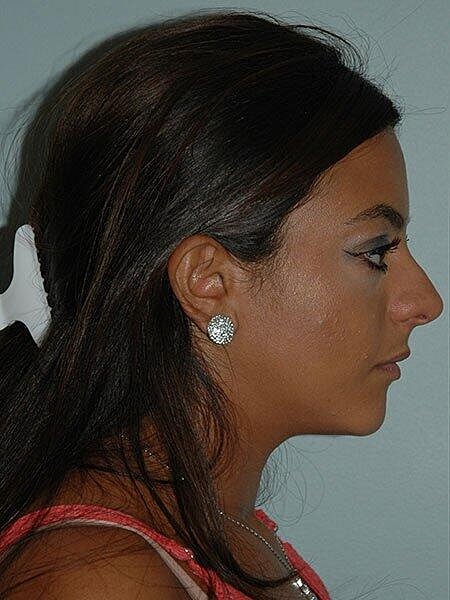 Rhinoplasty Before & After