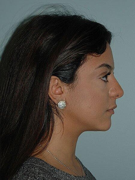 Rhinoplasty Before & After