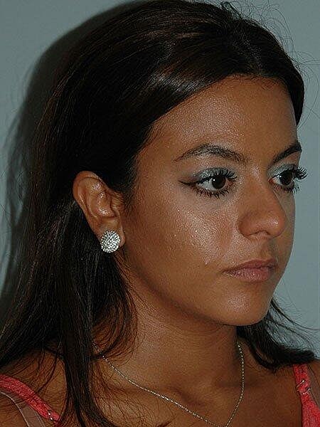 Rhinoplasty Before & After
