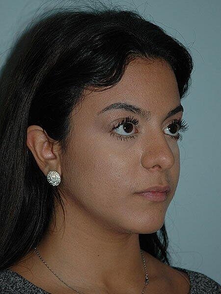 Rhinoplasty Before & After