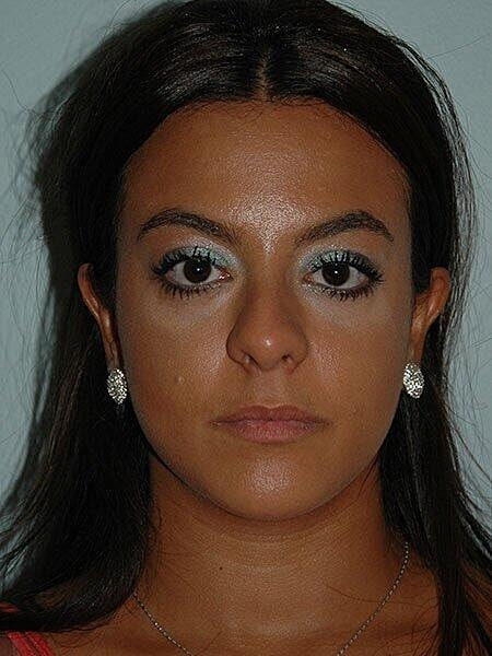 Rhinoplasty Before & After