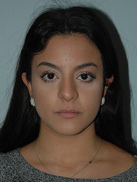 Rhinoplasty Before & After