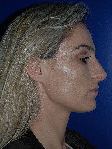 Rhinoplasty Before & After
