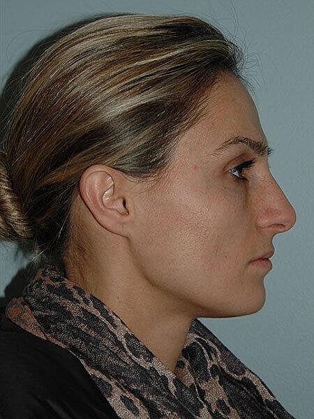 Rhinoplasty Before & After