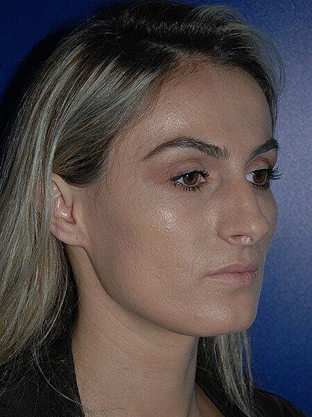 Rhinoplasty Before & After
