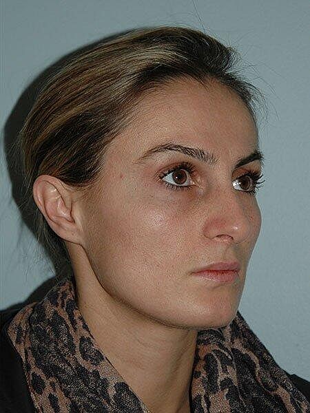Rhinoplasty Before & After