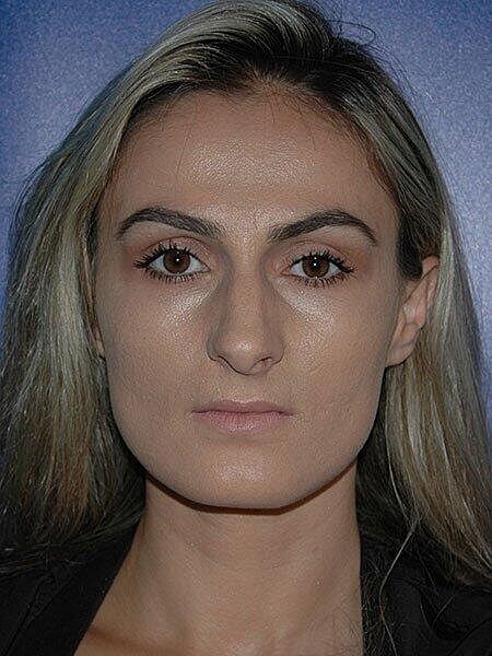 Rhinoplasty Before & After
