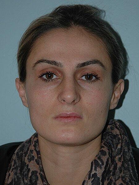 Rhinoplasty Before & After
