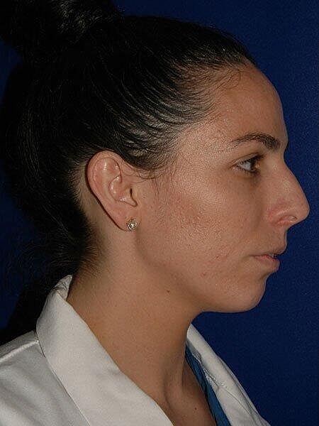 Rhinoplasty Before & After