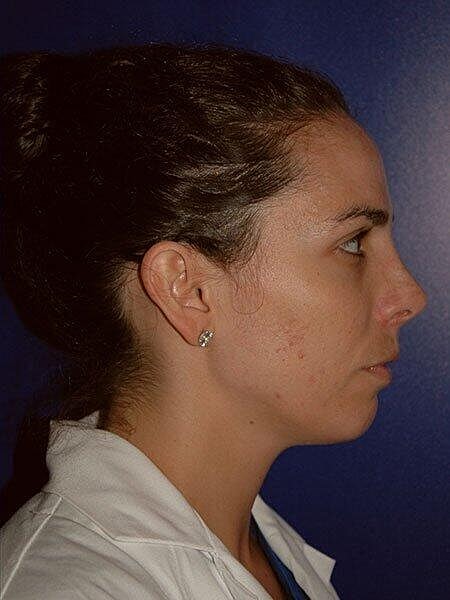 Rhinoplasty Before & After