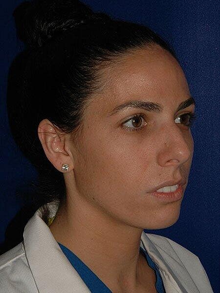 Rhinoplasty Before & After