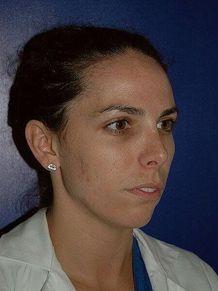 Rhinoplasty Before & After