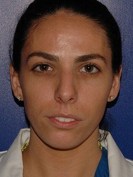 Rhinoplasty Before & After