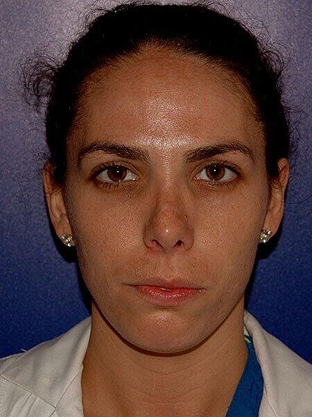 Rhinoplasty Before & After