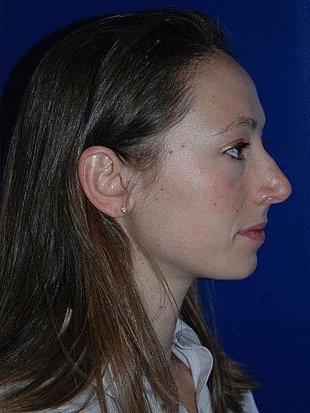 Rhinoplasty Before & After