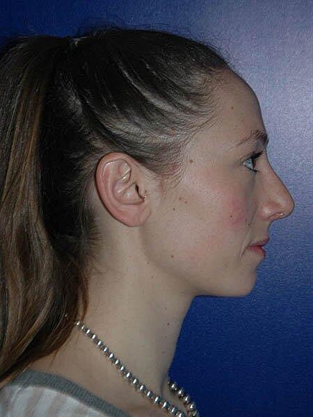 Rhinoplasty Before & After
