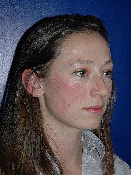 Rhinoplasty Before & After