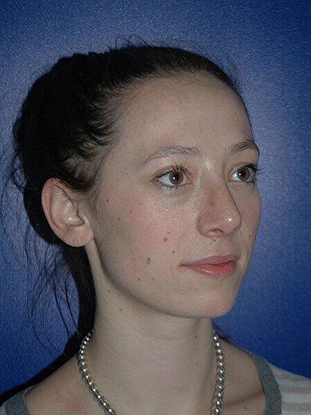 Rhinoplasty Before & After