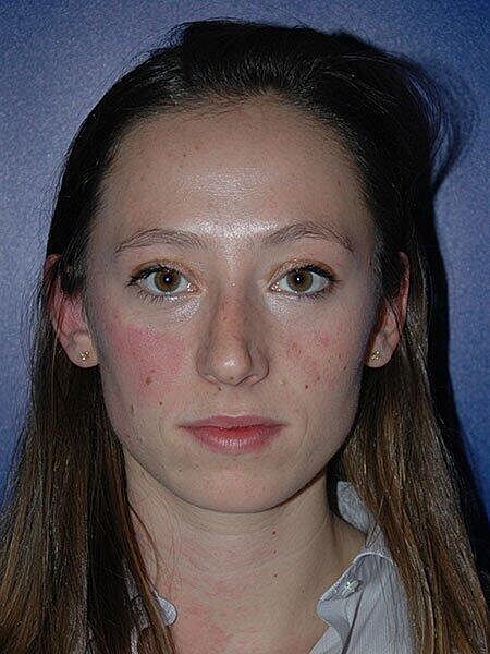 Rhinoplasty Before & After